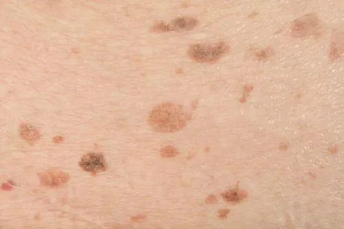 Close-up of skin showing dark spots