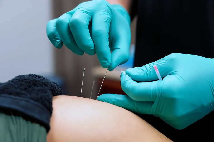 Dry Needling treatment