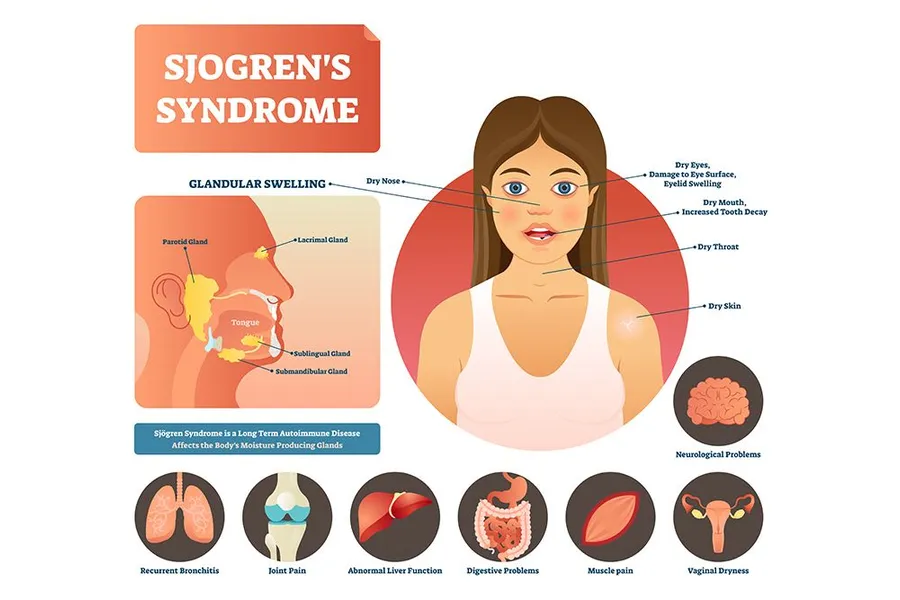 Sjogren Syndrome