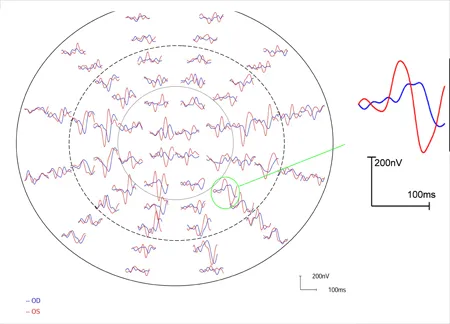 Pattern Visual Evoked Response Test Image