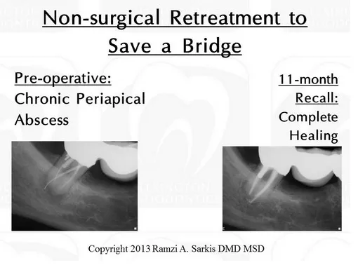 Microendodontics Case 3