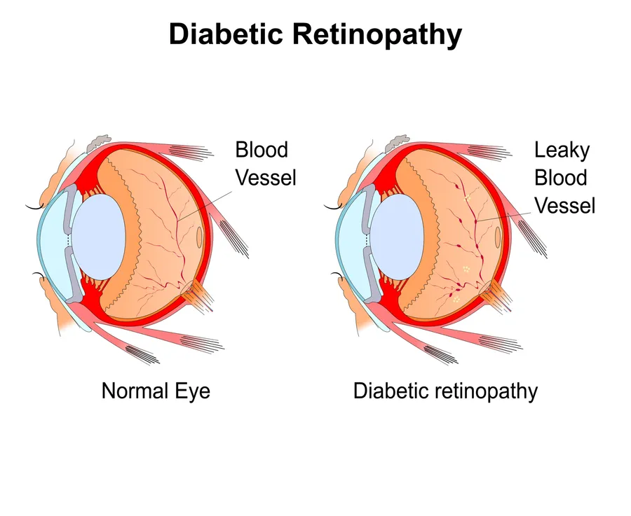 Diabetic Eye Diagram