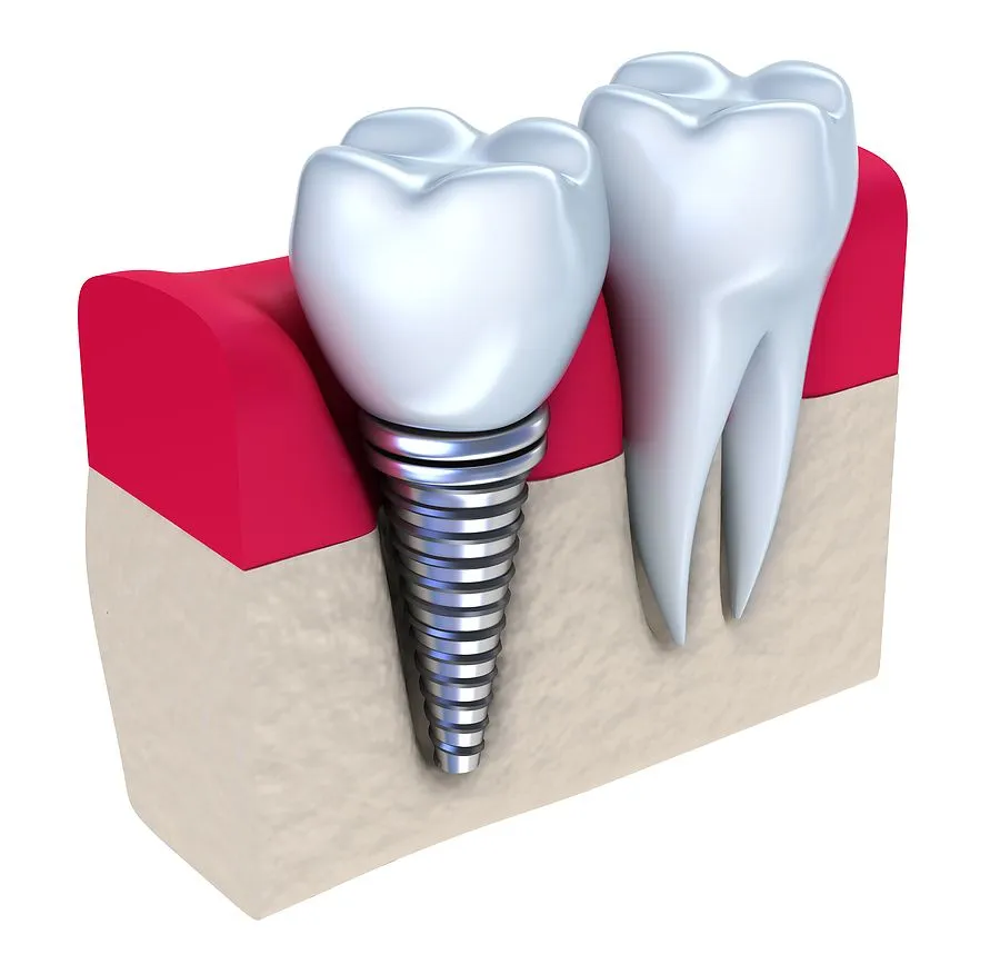Dental Impalnt, Victorville Dentist and Orthodontist