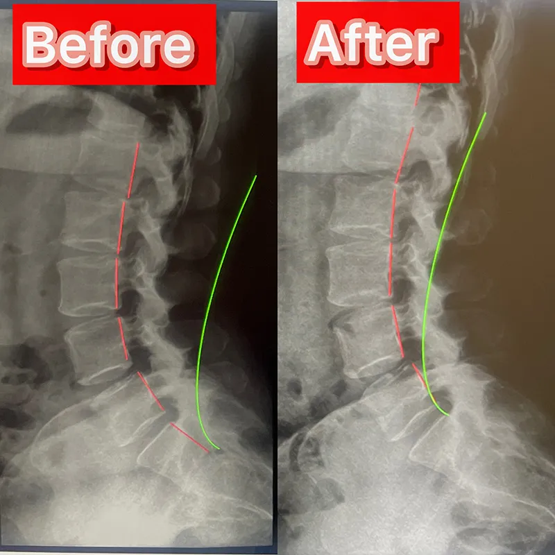 posture correction x-ray