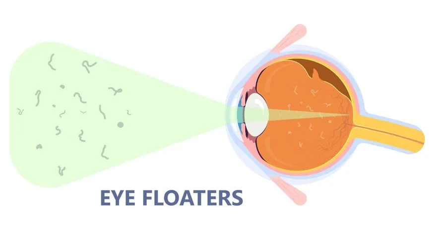 eye floaters