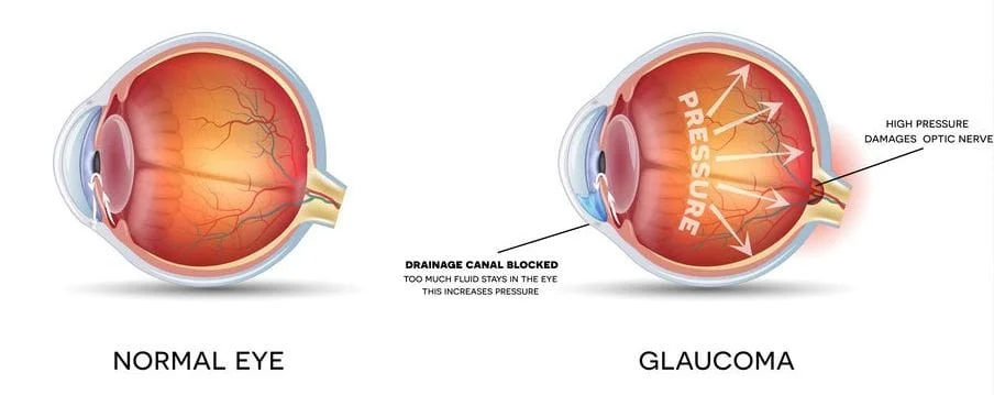 Glaucoma eye doctor in Idaho Falls, Pocatello, Rexburg and St. Anthony.