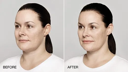 38 year old female treated with restylane Lyft