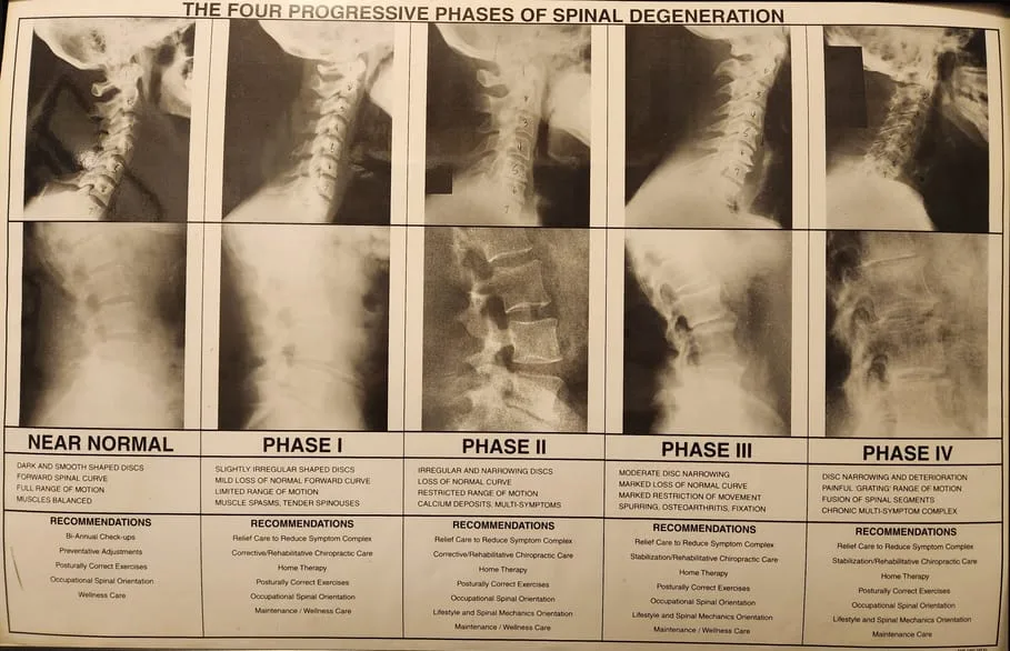 Pictures and Descriptions of the 4 phases of spinal degeneration