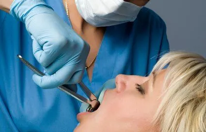 dentist using dental pliers to extract woman's tooth, tooth extractions Bradenton, FL dentist