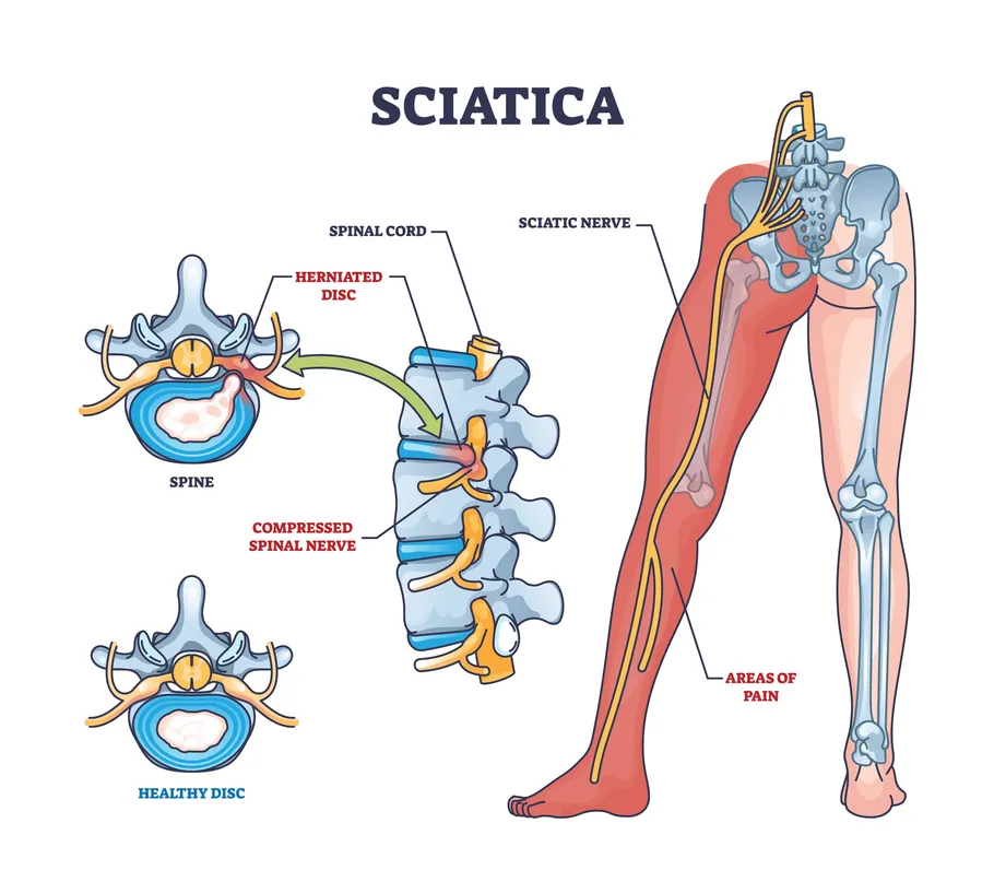 sciatica chart