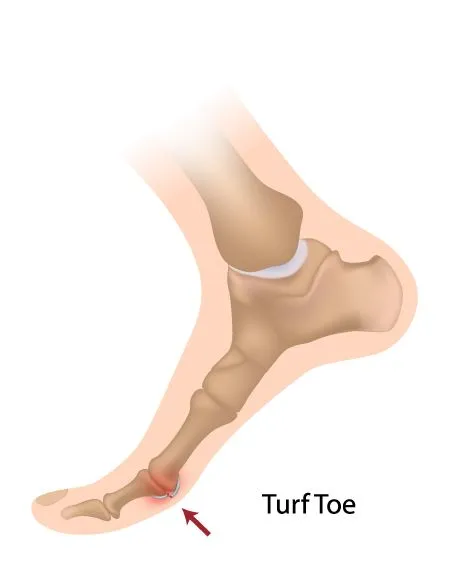 Turf Toe