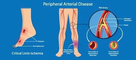 Peripheral Arterial Disease PAD