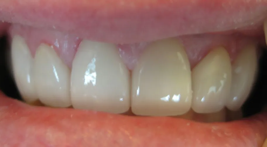 Veneers in Reston, VA