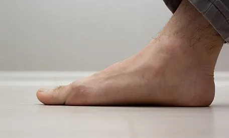 Flat Feet