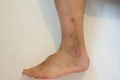 Lisfranc Injury