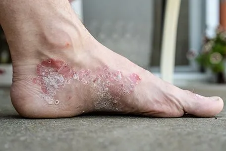 Psoriasis