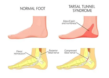 Tarsal Tunnel Syndrome