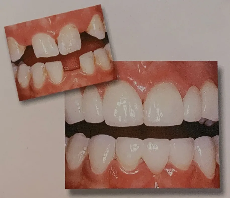 Crowns and Bridges | Cosmetic Dentistry in Reston, VA