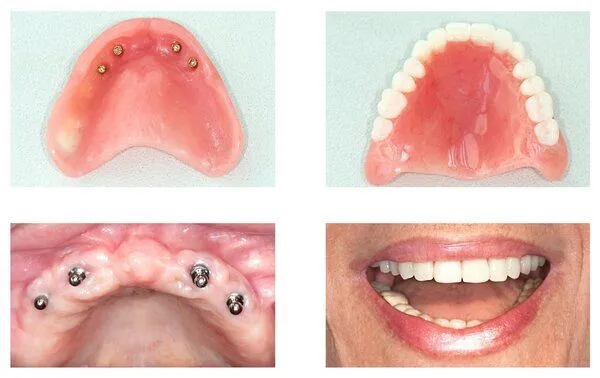 collage of images showing implants being placed in mouth for implant-supported dentures Baker City, OR dentist