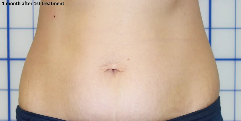 After skin tightening