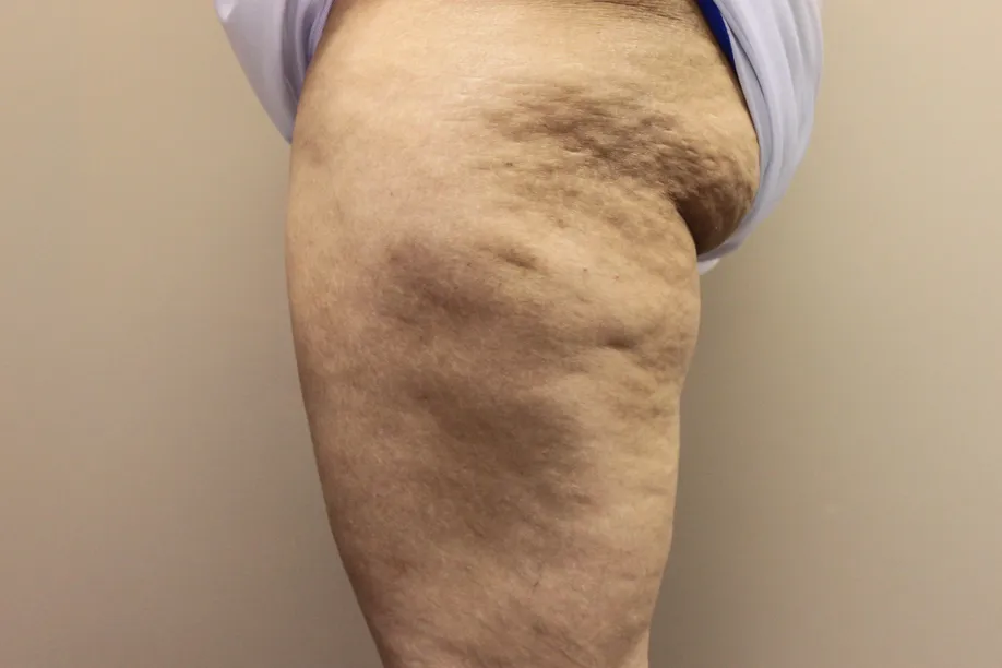 Cellulite before treatment