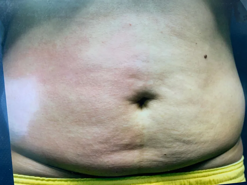 Before Alma Treatment