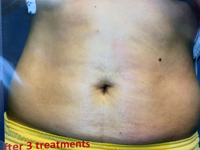 After 3 Alma treatment