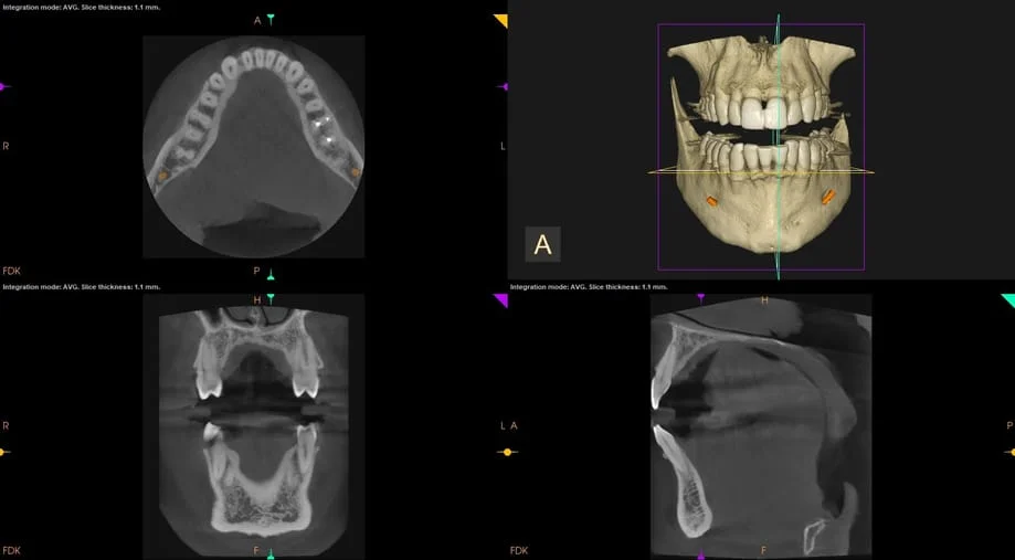 X ray taken with CBCT Machine
