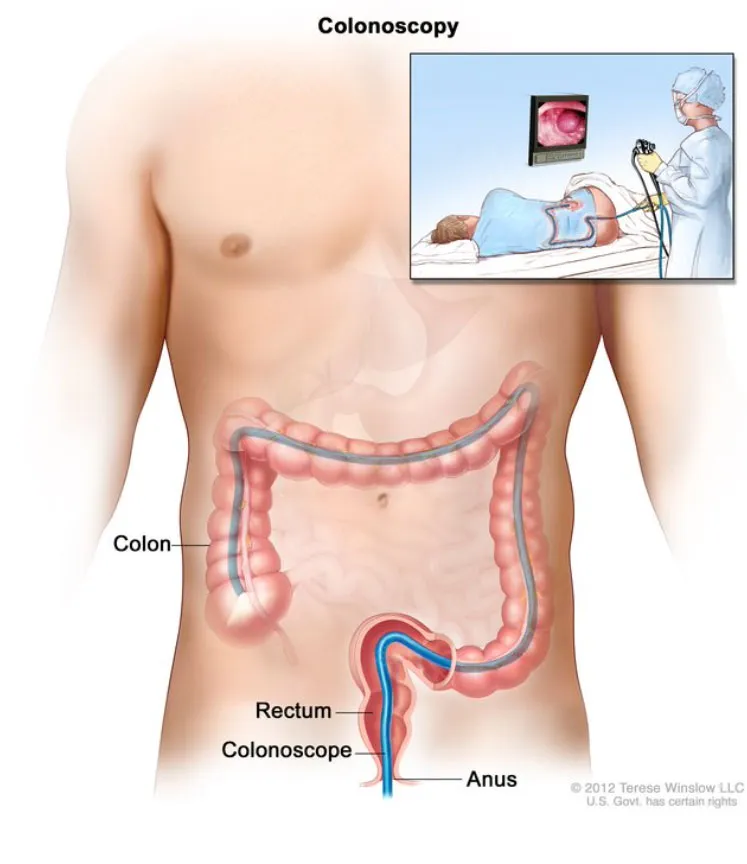 colonoscopy