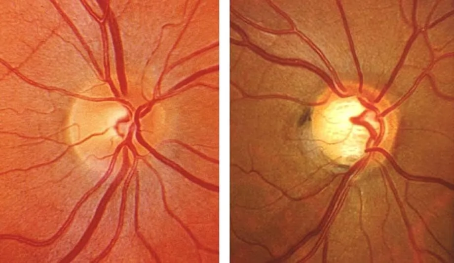 optic nerve glaucoma