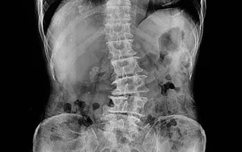 Scoliosis