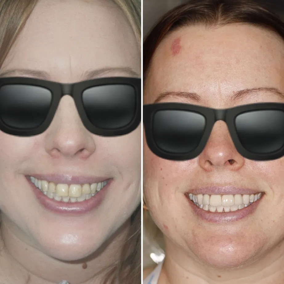 before and after image of woman's teeth after cosmetic dentistry Brookline, MA cosmetic dentist