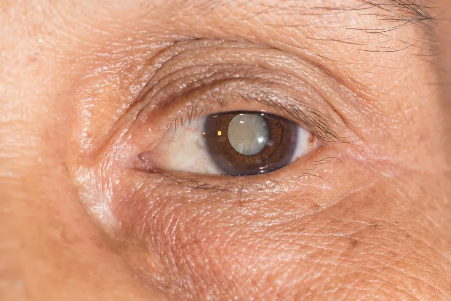 eye with cataract