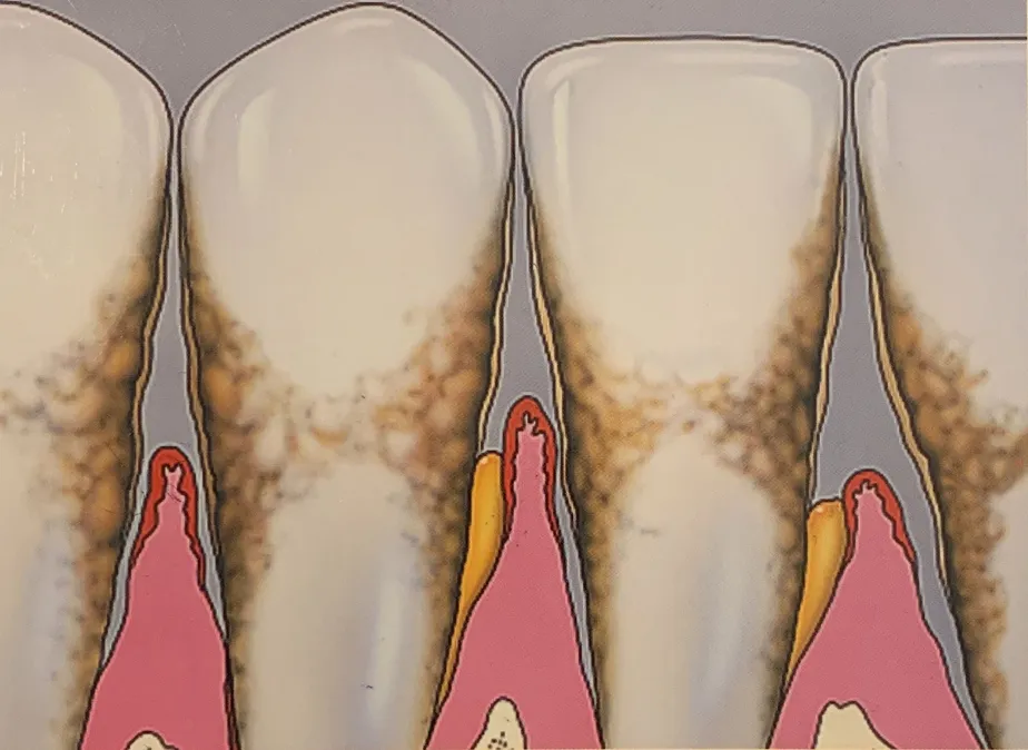 Gum Disease in Reston, VA