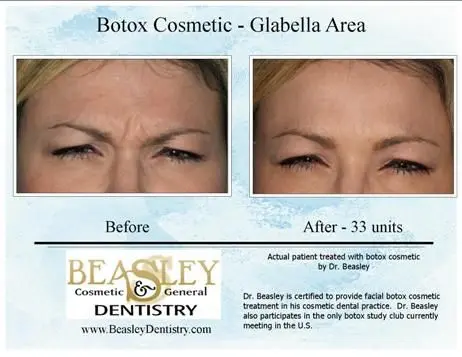 Before after of Huntsville botox.