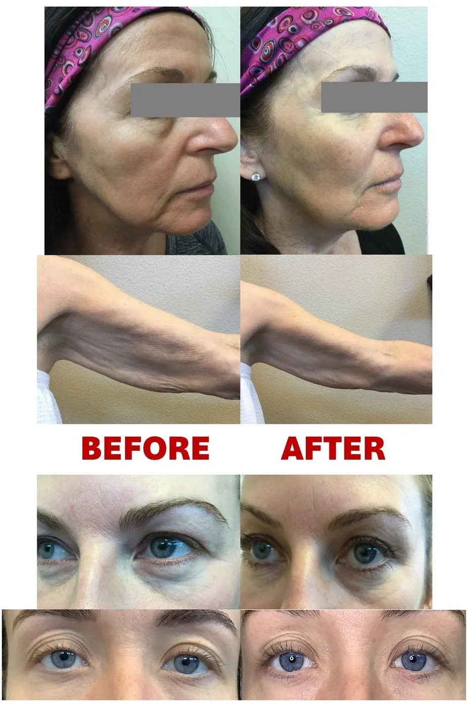 Thermage Before & After