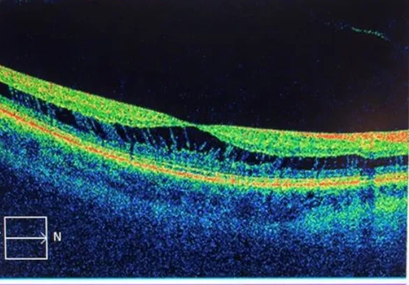 retina cross section