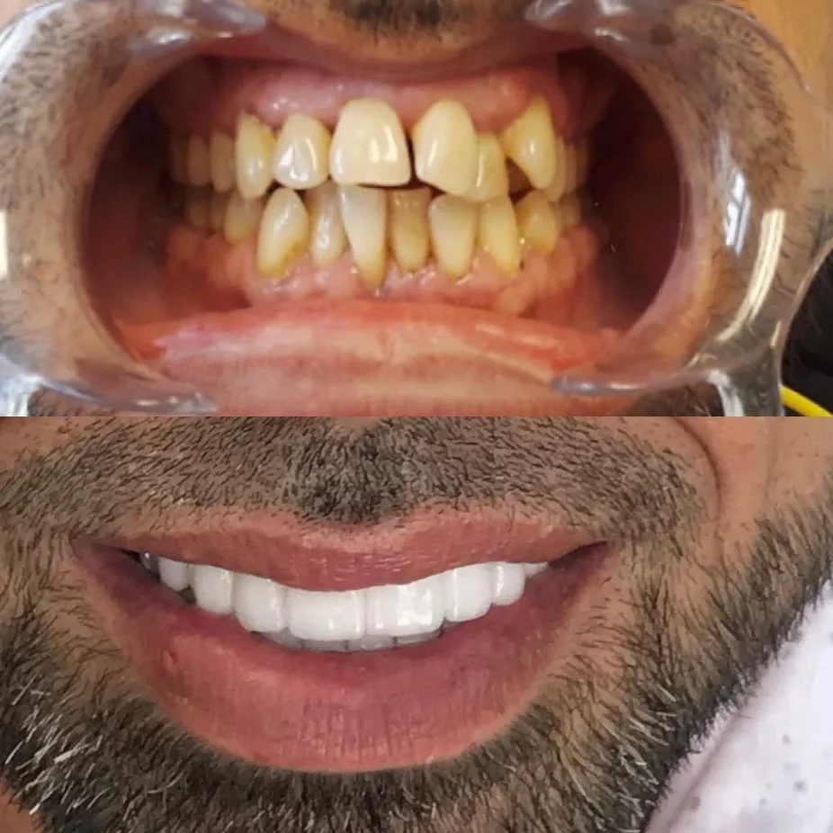 Veneers