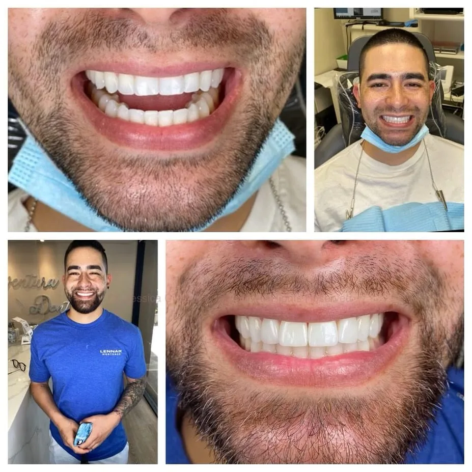 Before and after images of a completed full mouth restoration done by Dr. Jessica Cismas at Aventura Dental Group, your friendly local Aventura cosmetic dentist.