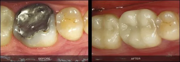 Before and After CEREC - Glen Cove, NY Dentist | Joseph M. Buono, DDS