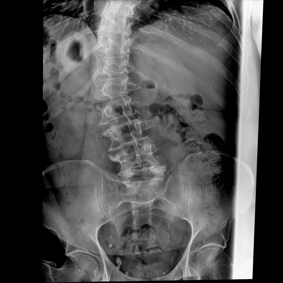 Scoliosis