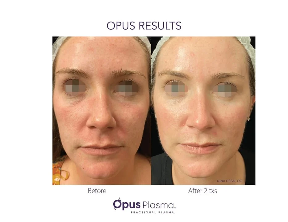 Opus face results
