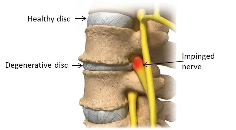 Disc Herniated 