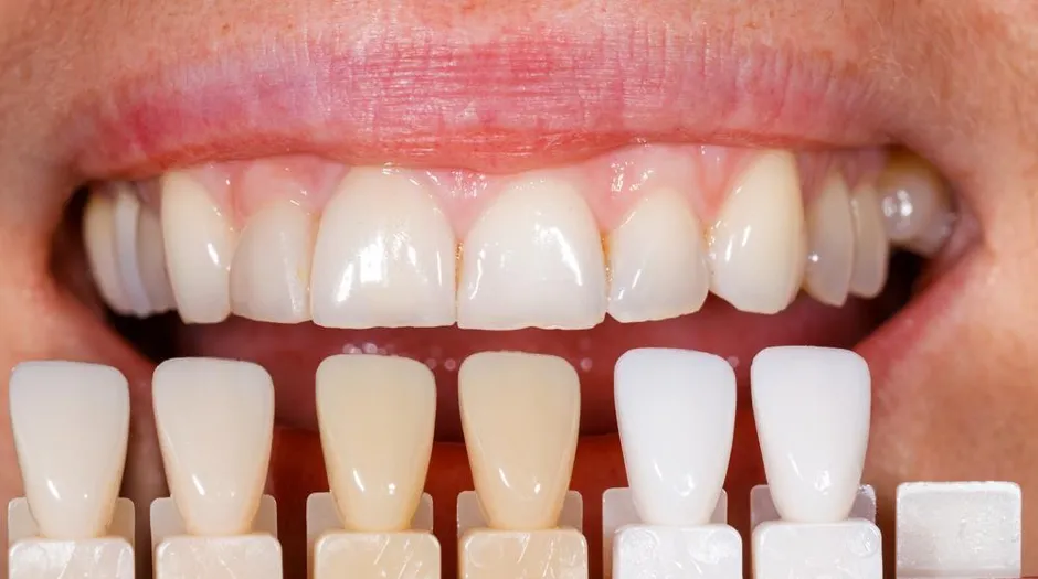 Preparation for Veneers