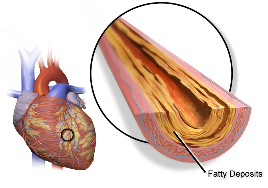 Cholesterol and Blood Pressure Screenings, Coronary heart disease