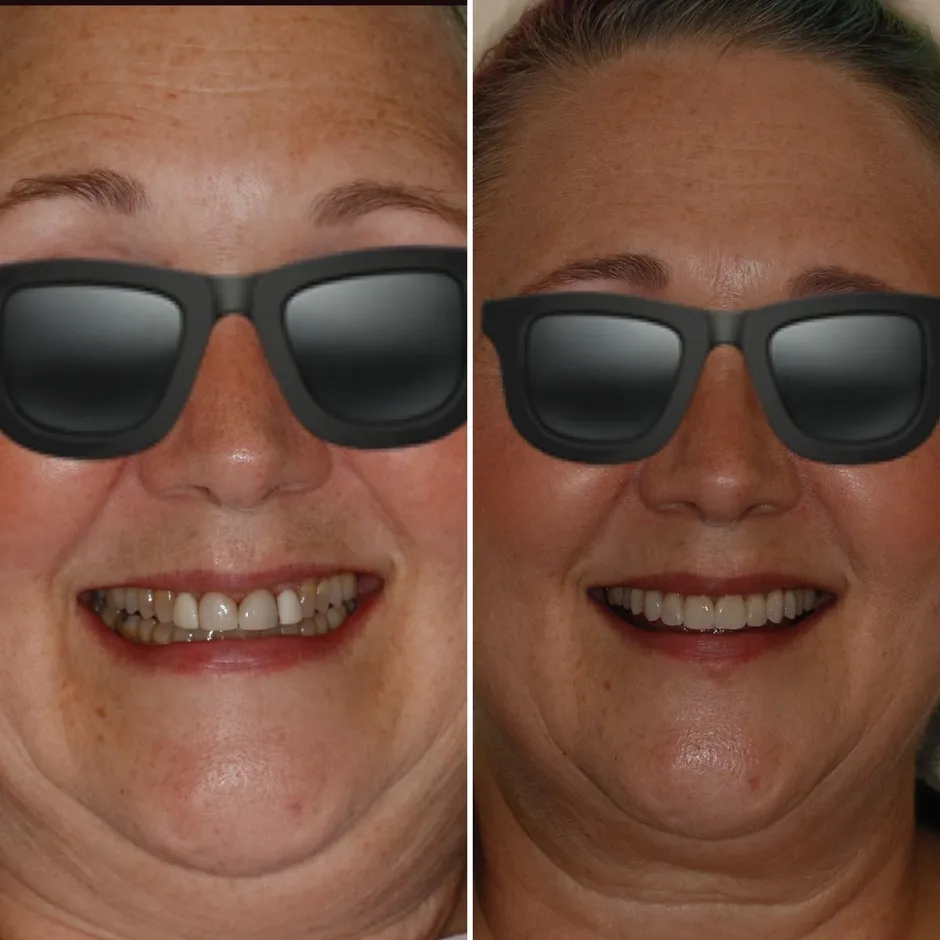 before and after image of woman's smile after getting cosmetic dentistry Brookline, MA cosmetic dentist