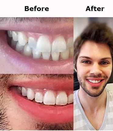 Invisalign_express_treatment.jpg