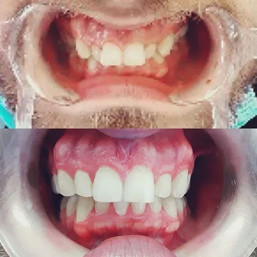 invisalign