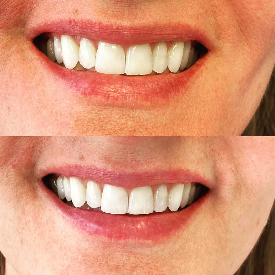 Before_After_EnamelRecontouring