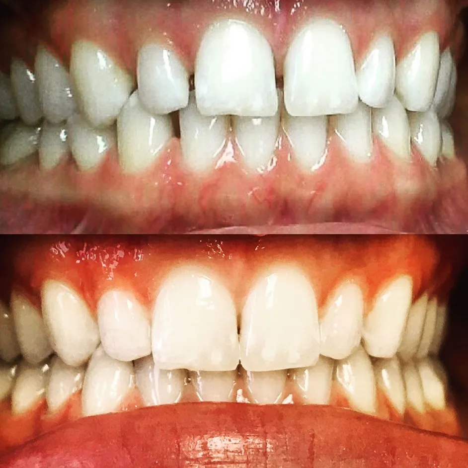 invisalign